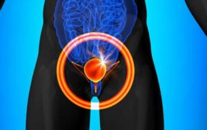 Bladder Cancer