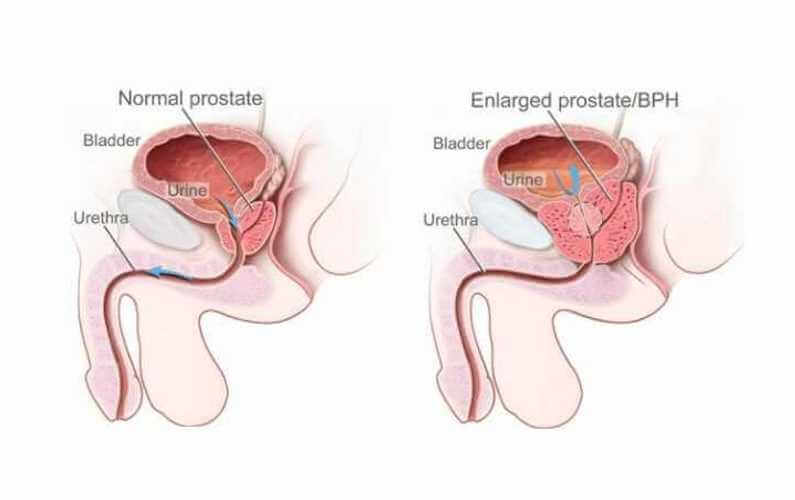calculse prostatitis c