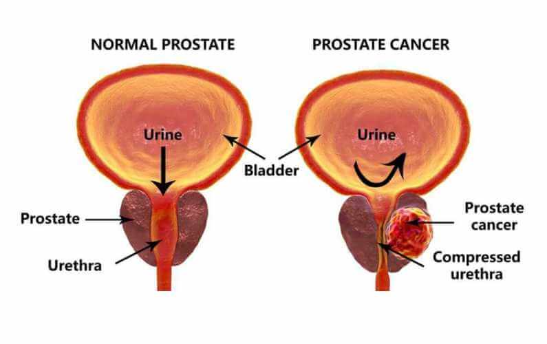 prostatitis és vodka prostate cancer rectal invasion