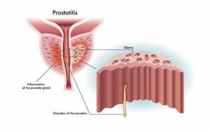 van prostatitis van