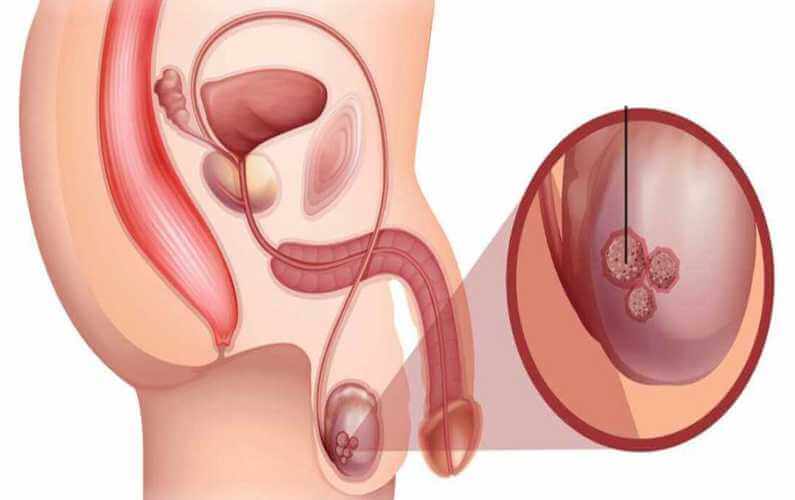 testicular lump