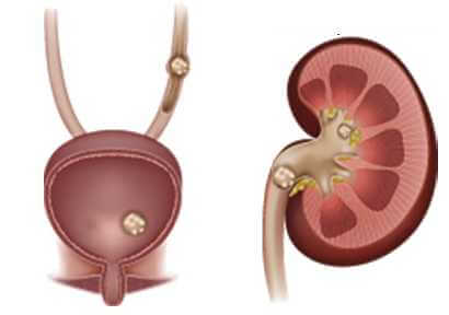 Kidney Stones