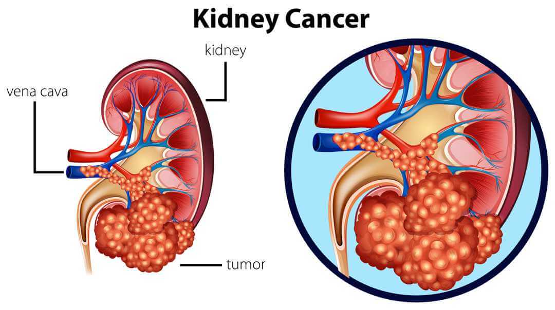 Kidney Cancer