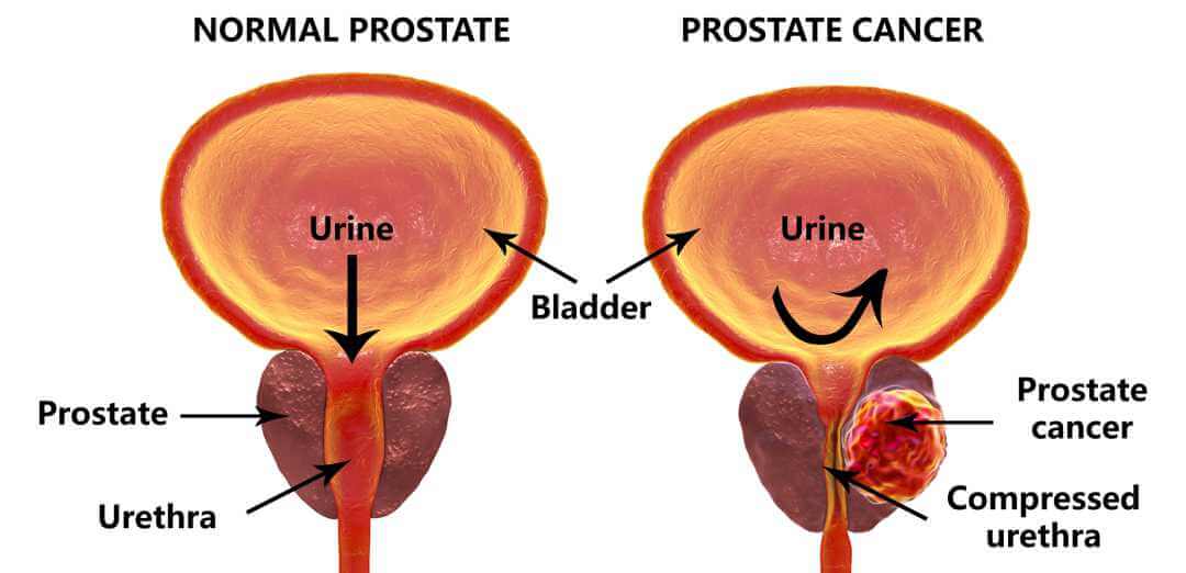 rak prostate