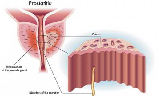 prostatitis vomot)