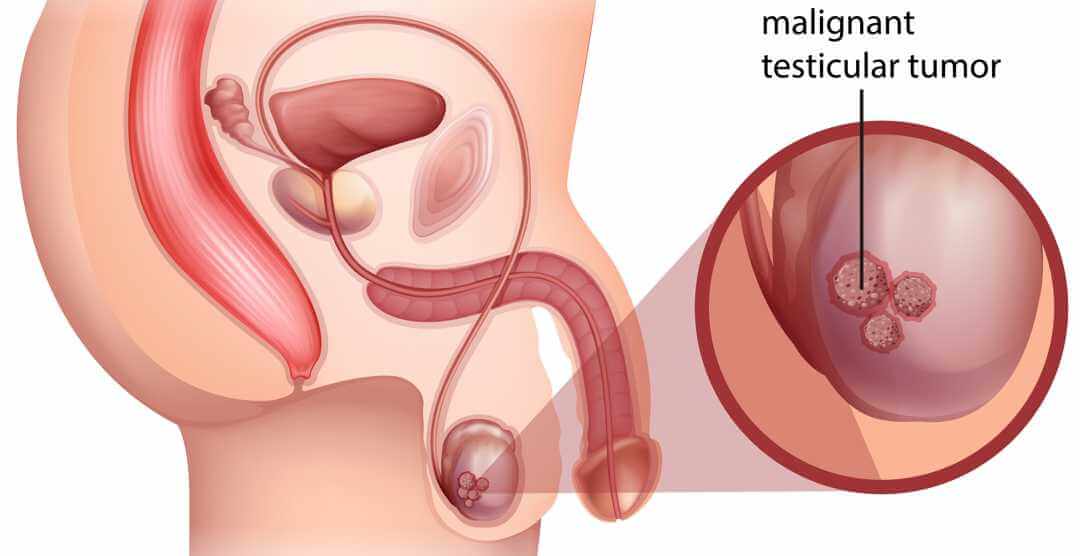 Testicular Cancer