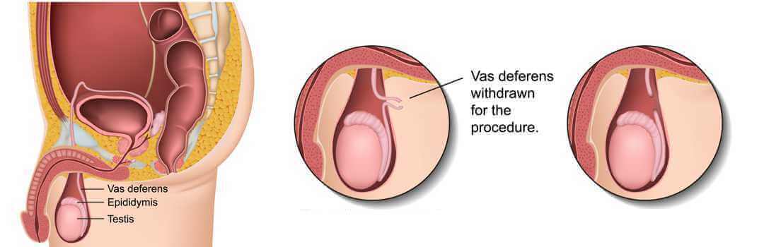 Vasectomy In Seattle Wa